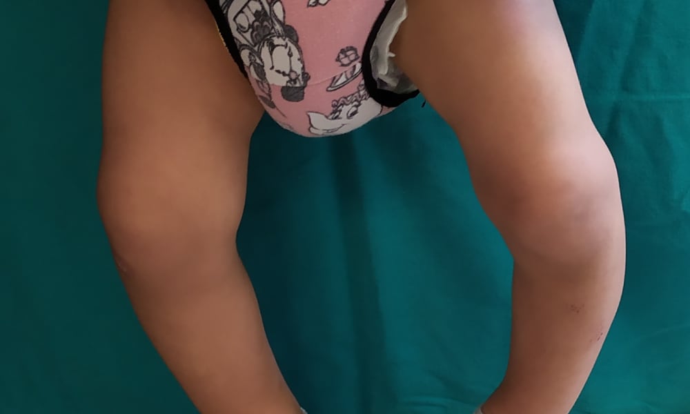 Kemiklerde Şekil Bozuklukları