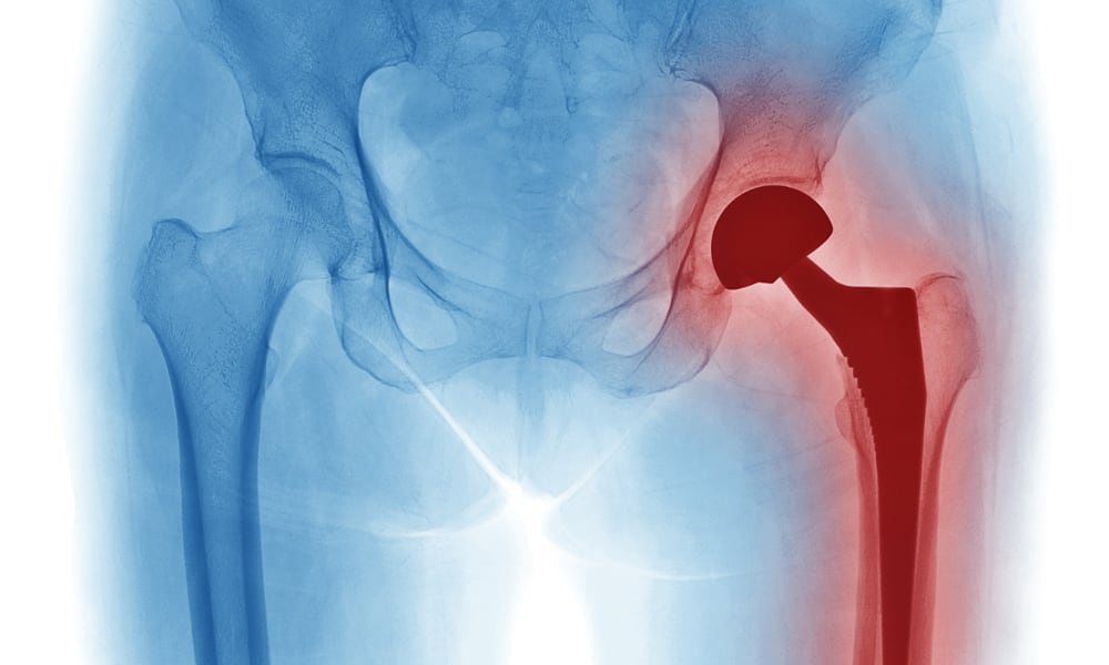 Protez Enfeksiyonları