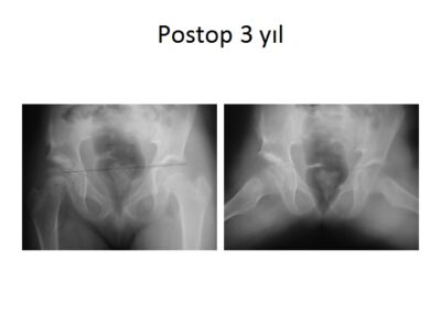 Yediden 77’e Kalça Hastalıkları