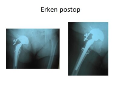 Yediden 77’e Kalça Hastalıkları