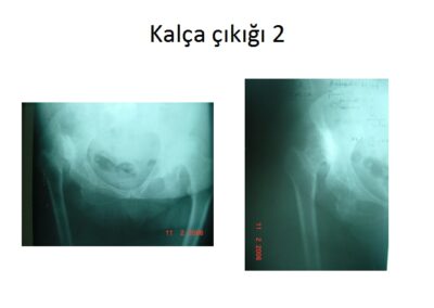 Yediden 77’e Kalça Hastalıkları