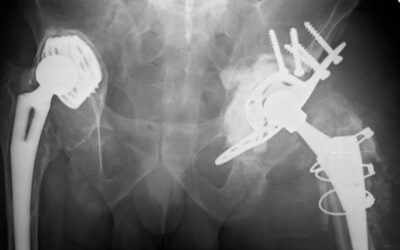 Protez Çevresi Enfeksiyon